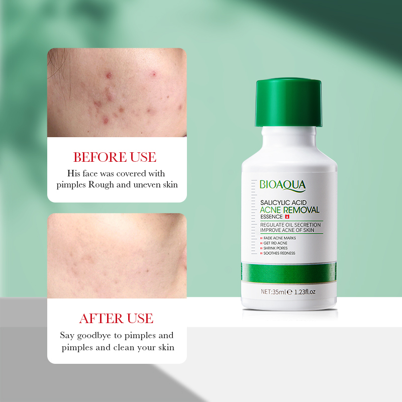 35ml BIOAOUA Salicylic Acid An - Salicylic Acid Blackhead Remover recension och pris