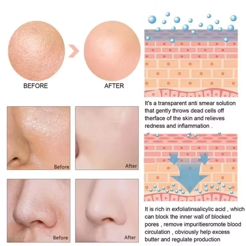 Salicylic Acid Pore Shrinking  - Salicylic Acid Blackhead Remover recension och pris