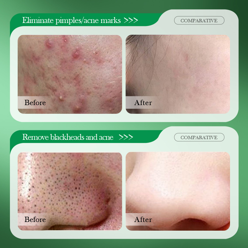 Salicylic Acid Acne Treatment  - Salicylic Acid Blackhead Remover recension och pris